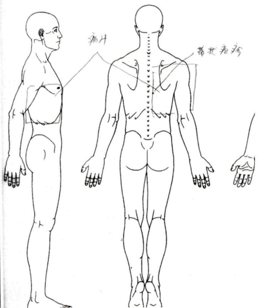 図1（受診時に患者さん自身が記載した疼痛部位と皮疹部位）